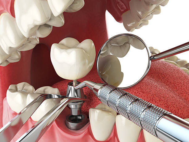 Best Emergency Tooth Extraction in Canterwood, WA